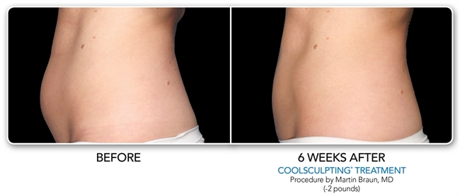 Before and After CoolSculpting Beverly Hills