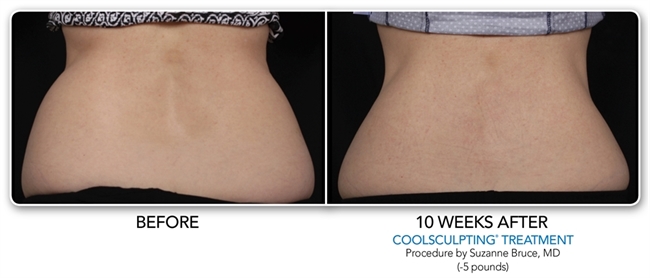 CoolSculpting Before and After Beverly Hills