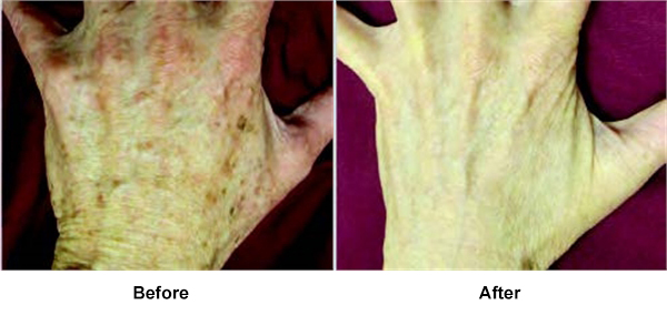 Brown spotted hand BBL treatment