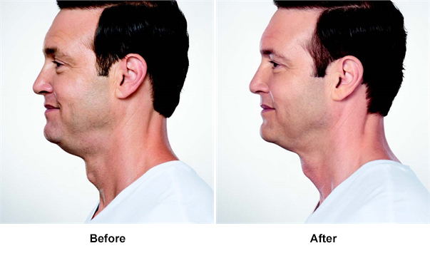 Before and After Kybella Beverly Hills CA