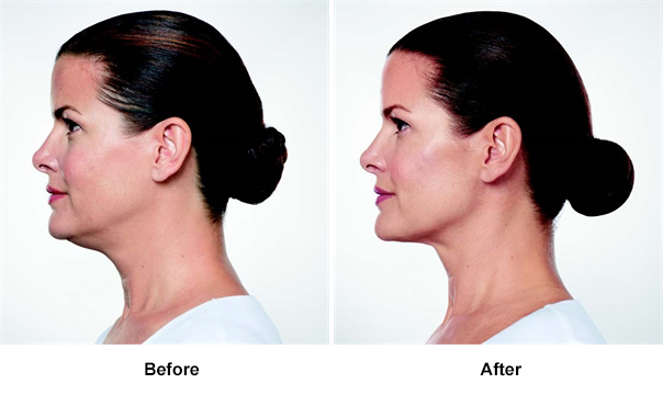 Kybella Before and After Beverly Hills CA