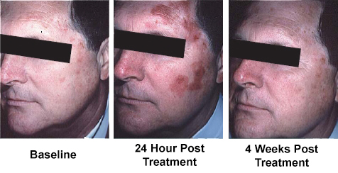 Before and After Photodynamic Therapy Beverly Hills