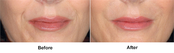 Before and After Restylane Beverly Hills
