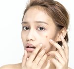 Tip of the Month: Prevent Acne Scarring image