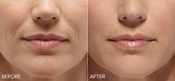 Belotero Balance Injectable Filler Before and After