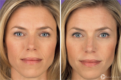 Juvederm Beverly Hills Before and After