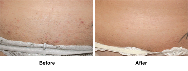 Before and After laser hair removal Beverly Hills