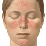 Rosacea and What To Do About It. image