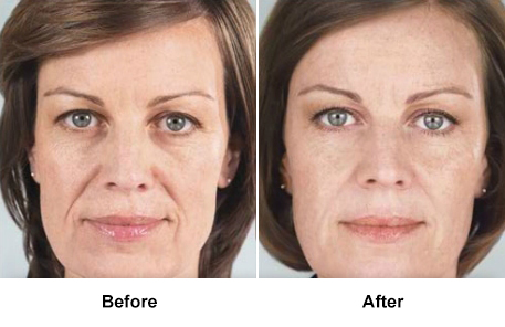 Before and After Sculptra Beverly Hills