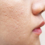 ACNE SCARS CAN BE MORE THAN SKIN DEEP image