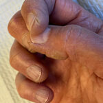 Fingertip Fissures – Tips for Healthy Skin image